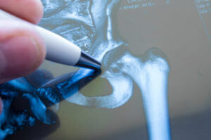 Benefits of Joint Replacement Surgery