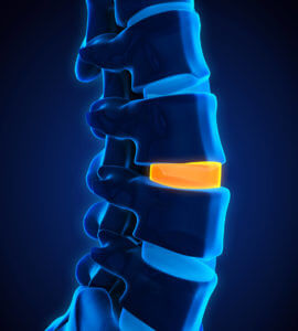 Can Degenerative Discs Heal On Their Own