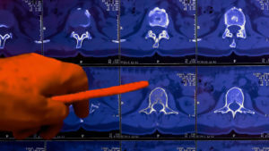 Common Symptoms of Degenerative Disc Disease