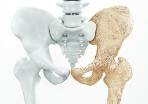 Hip Fractures