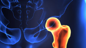 Hip Fractures