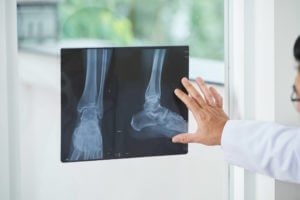 Common Types of Ankle Fractures