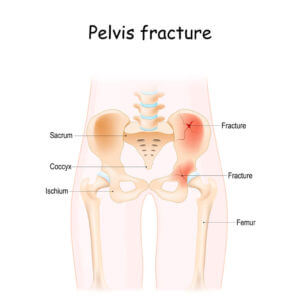 Pelvic Insufficiency Fracture