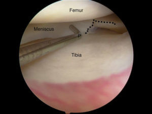 Treating Meniscal Tears
