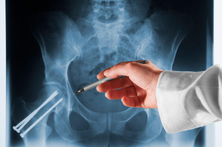 Types of Hip Fractures