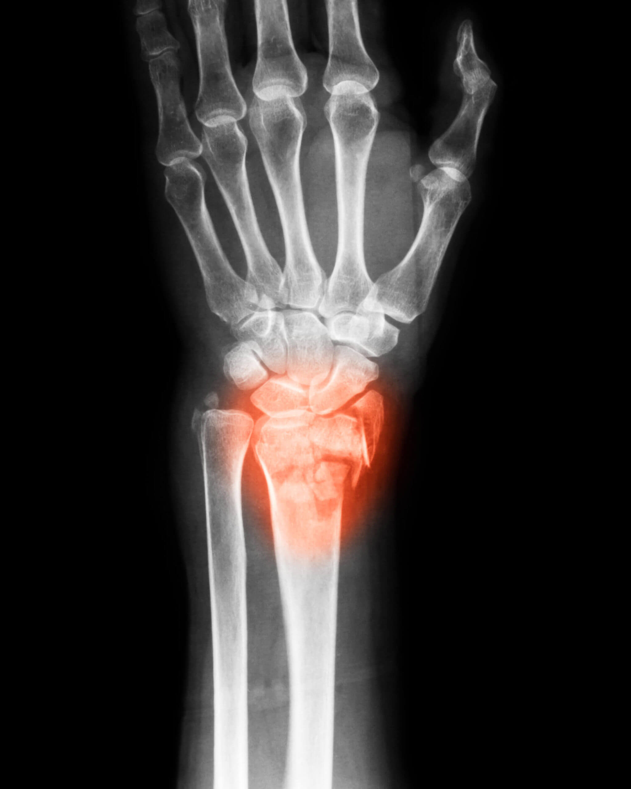 Scaphoid Fracture Causes Symptoms Diagnosis Treatment vrogue.co