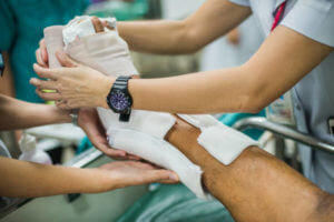 Patient with broken leg and splinted for treatment in the hospital.