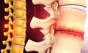 3D illustration of human spine anatomy showing signs of degenerative disc disease, which can lead to lower back pain.