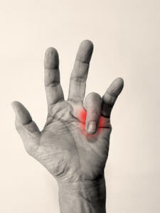 Image of a person's hand affected by trigger finger disease.