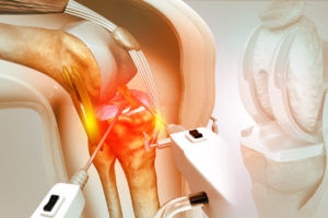 3D illustration of the Human knee replacement surgery.