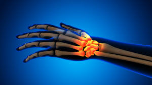A 3D illustration depicting wrist joint pain resulting from a hand bone fracture.