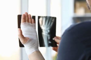 A man's hand is bandaged due to fractures, and he is holding an X-ray image up close.
